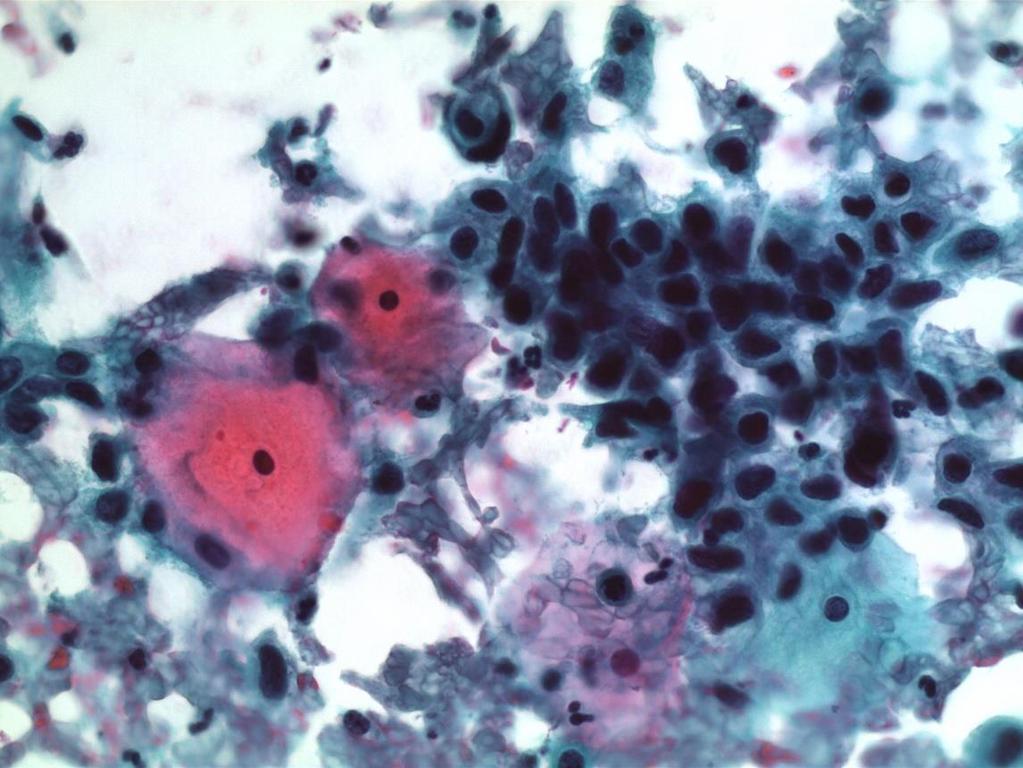 Cytology and biopsy repeated on admission to the