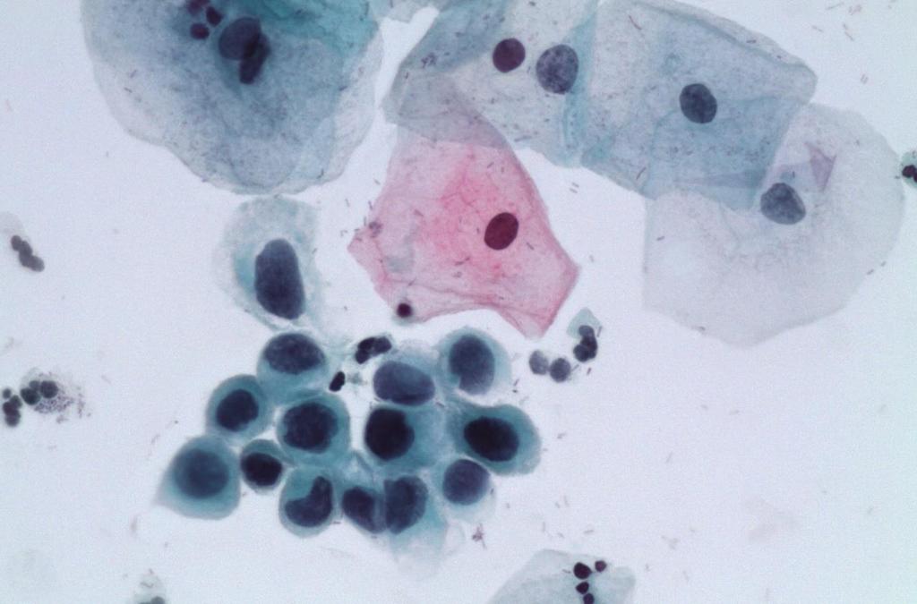 Cytology false negative, in revision