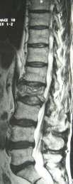 Incidence 80% of spine metastatic tumour disease primarily originate from - Lung - Breast - Prostate
