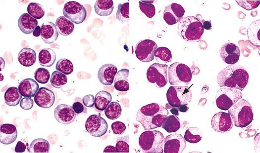 MM : Further examination Bone marrow (aspirate & biopsy) - Key component to diagnosis - Morphology : % plasmacytosis (diagnostic criterium) - due to patchy BM involvement, aspirate and biopsy may