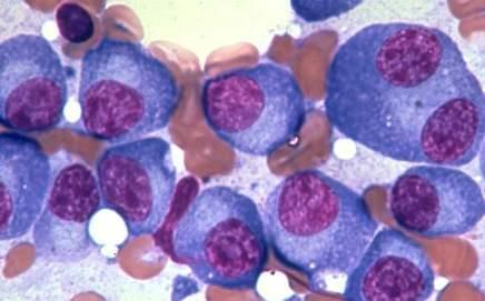 Ontogenesis of myeloma : A plasma cell disease Proliferation of malignant plasma