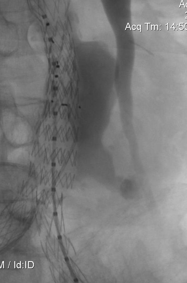 Completion angiography: type II EL intrasac embolization Vascular Surgery - University of Florence, University of Rome Tor Vergata 372