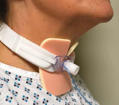 Tracheostomy When a patient needs ventilating for several days or weeks the Critical Care team may decide that a tracheostomy would be advantageous.