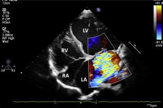 11 YEARS Increasing abdominal distention present Echocardiography showed