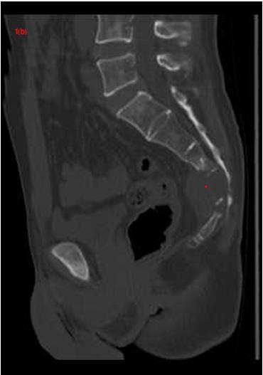 Figure 1 a-b: CT shows bone