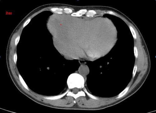Figure 2a-c: CT plain scan showed irregular mass on the right side of anterior mediastinum with