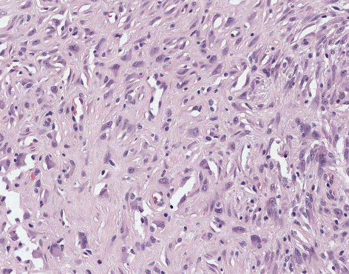 Summary Epithelioid fibrous histiocytoma is a distinct neoplasm with recognisable