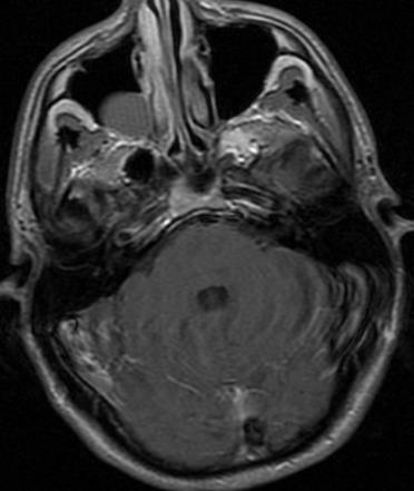 MRI of the brain: