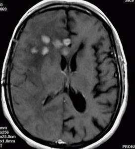 brain MRI: