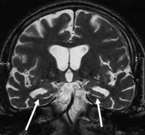 Alzheimer dementia parietal and temporal cortical atrophy disproportionate