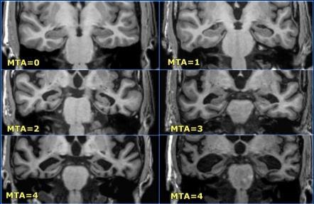 Scheltens-Skala: medialtemporal lobe atrophy score width of the choroid