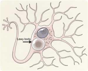Lewy body disease normal brain
