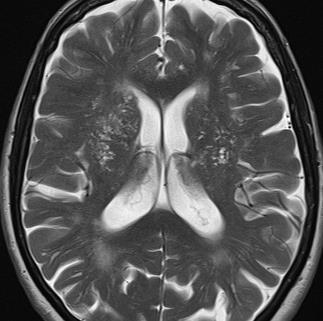 MRI of the brain T1, T2 (anatomy, pathology) dark CSF (FLAIR)