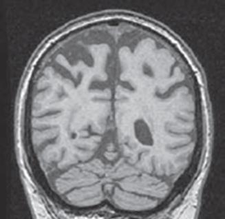 corticobasal degeneration asymmetric cortical atrophy (superior