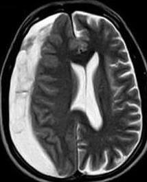neurodegenerative-like signs meningioma (anterior cranial