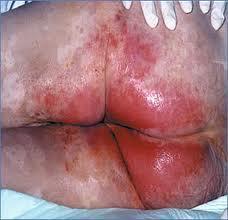 IAD What it is A reactive skin response to chronic exposure to urine & faeces-+ Could be observed as inflammation, erythema +/-