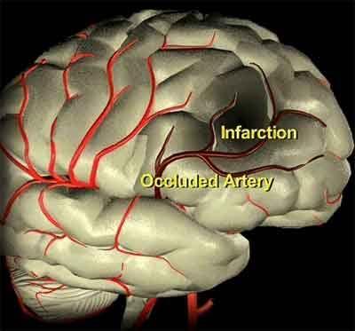 What causes ischemic stroke? Different than MI.
