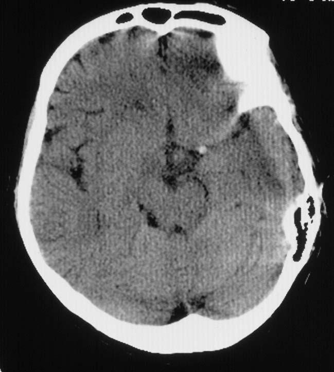 Acute Stroke Intervention 39 year old woman Mother of 4 yo boy Sudden collapse