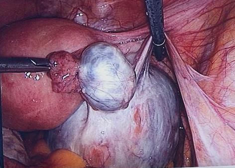 Surgical treatment of early stage borderline tumors Radical - bilateral salpingo-oophorectomy Conservative - monolateral salpingo-oophorectomy