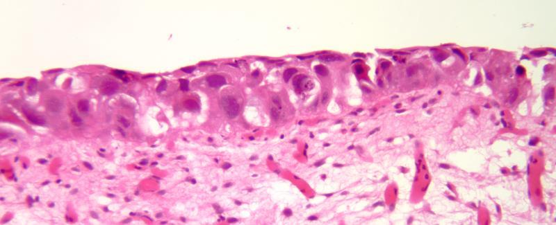 CARCINOMA IN SITU Large cells,