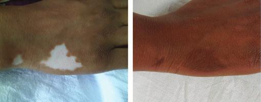 repigmentation. Before surgery; 16 weeks after surgery. Fig 3.