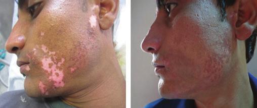 of segmental vitiligo over the face showing near 100% repigmentation.