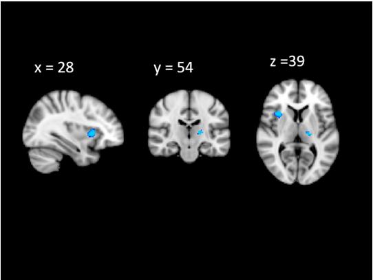 efigure 3. Patterns of Gray Matter Atrophy in Changed vs Unchanged Status Uncorrected at p < 0.