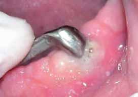 clinicians. Peri-implantitis is a disease of inflammatory nature which leads to the loss of the implant when left untreated.