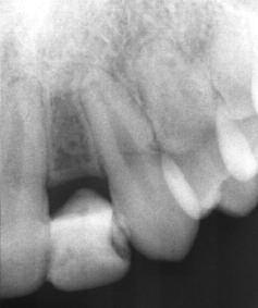 Key words: Narrow diameter implant, congenitally missing lateral Clinical relevance Scientific Rationale for the paper: This article describes a patient managed using a narrow diameter implant in the