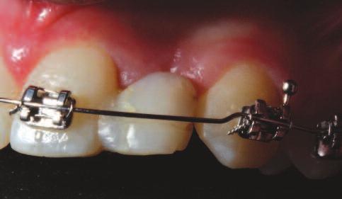 C A S E R E P O R T Figure 2: Orthodontic intervention, uprighting 21/23, picture and radiograph. Figure 3: SAC classification.