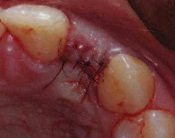 No vertical releases were made to avoid scarring and optimize blood supply to the flap. (Burkhardt & Lang 2014). On exposure of the alveolar ridge, the bucco-palatal dimension was approximately 3.