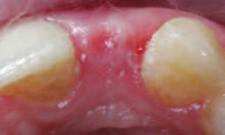 Figure 10: Picture of healing abutment and provisional modified Maryland bridge.