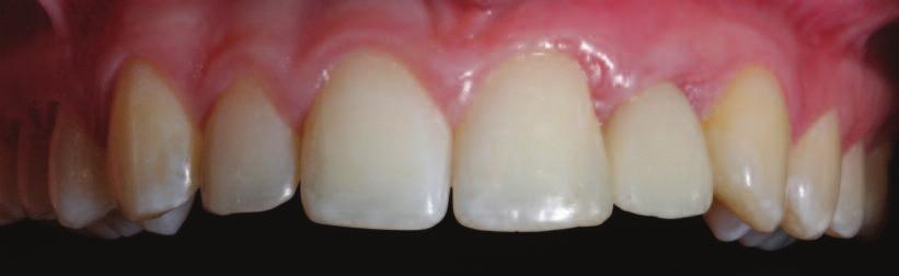 supported zirconia crown was constructed and placed (Figure 12 & 13).