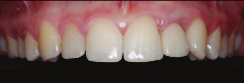 Figure 13: Definitive implant supported zirconia crown and radiograph. the prosthetic restoration of this case. Thank you to Dr Govindrau Mohangi for always being a mentor and outstanding teacher.