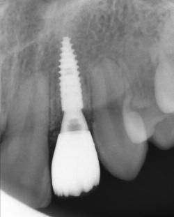 Long-term stability of early implant placement with contour augmentation. Journal of dental research, 92(12 Suppl), p.176s 82S. Buser, D., Martin, W. & Belser, U.C., 2004.