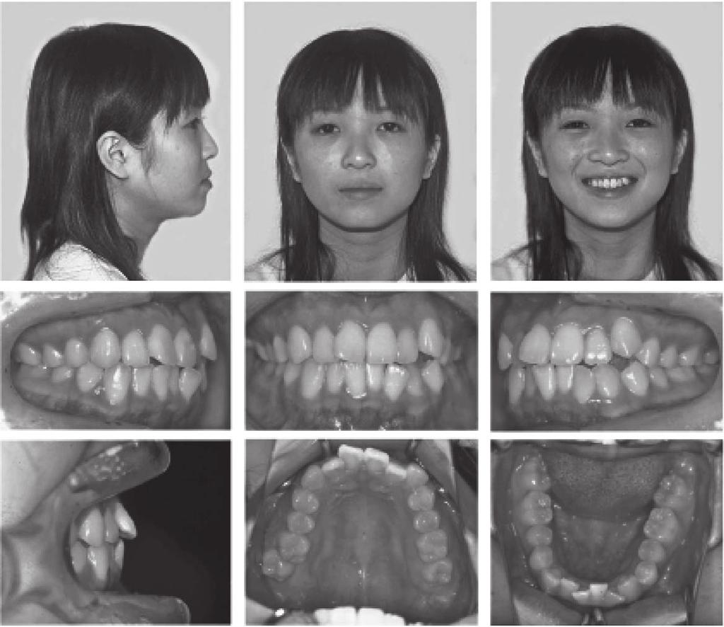 578 TAMAMURA, KURODA, SUGAWARA, TAKANO-YAMAMOTO, YAMASHIRO Figure 1. Pretreatment facial and intraoral photographs (age, 17 years 4 months). upper and lower lips were protruded (Figure 1).
