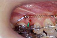 Fig. 20. Posterior buccal microimplants to intrude posterior teeth.