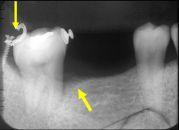 Fig. 23. Retromolar microimplant for retracton of whole mandibular dentition.