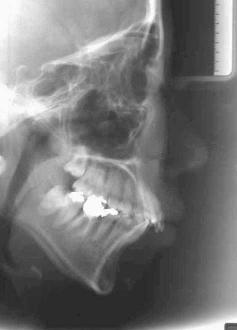 Intraorally, she had Class II canine and molar relationships (2 mm on the right and 1 mm on the left) with minimal maxillary and mandibular crowding.