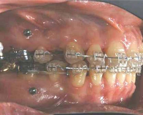 The use of mini-implants in en masse retraction for the treatment of bimaxillary dentoalveolar protrusion 37 Table 1 Cephalometric measurements.
