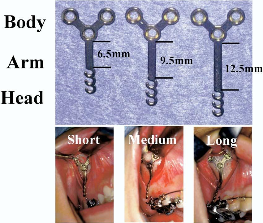 Volume 129, Number 6 Sugawara et al 725 Fig 1. Orthodontic titanium anchor plates for distal movement of maxillary molars. differences (Fig 1). The body portion was positioned subperiosteally.