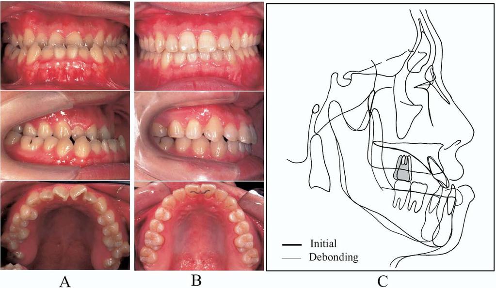Volume 129, Number 6 Sugawara et al 731 Fig 10. SAS treatment for decompensation in Class III surgical case (subject 20): A, initial; B, debonding; C, cephalometric superimposition.