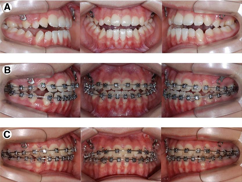 100 Baek et al Figure 3. Treatment progress. (A) After 15 months, the overjet was decreased. (B) The fixed appliance was placed. (C) Normal overbite and overjet were established.