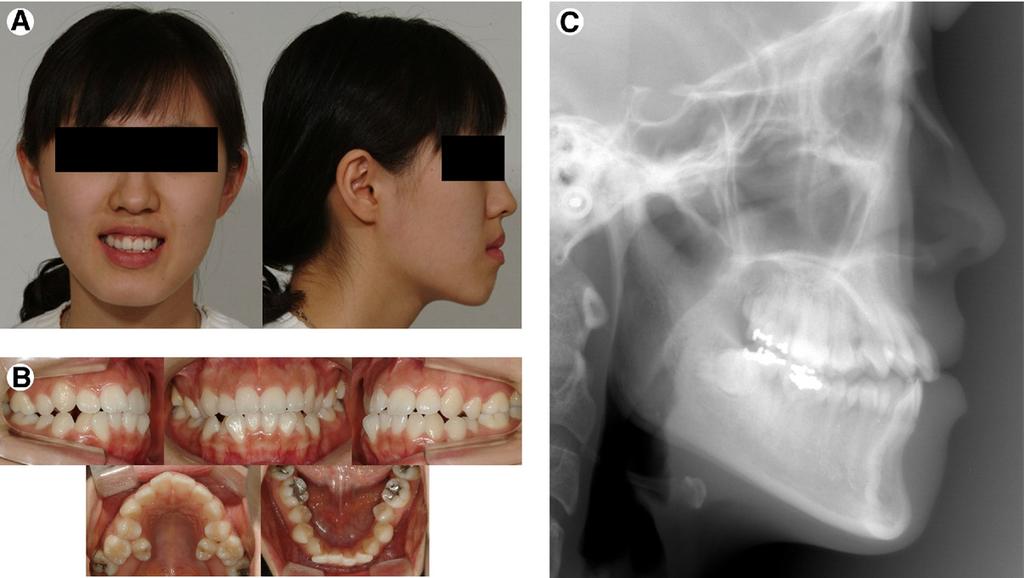 Class III Malocclusion and Miniplate/Mini-Implant 103 Figure 8. Initial records (T0). (A) Facial photographs. (B). Intraoral photographs. (C) Lateral cephalograms.