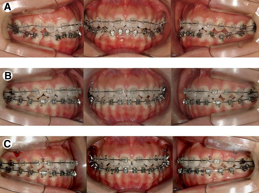 104 Baek et al Figure 9. Treatment progress. (A) After extraction of the upper second premolars, leveling and alignment were started.