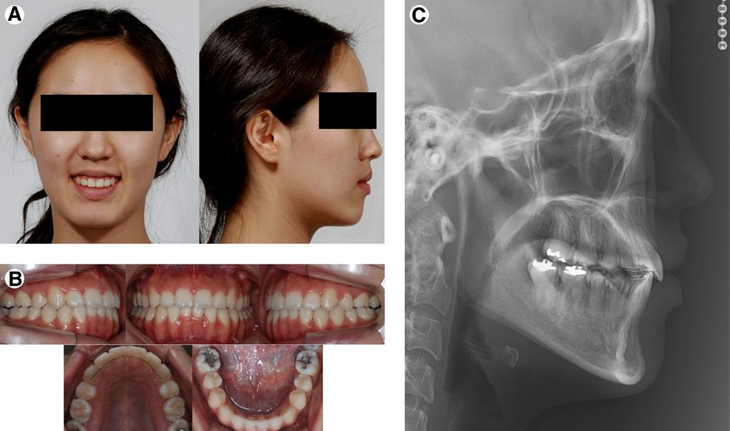 Class III Malocclusion and Miniplate/Mini-Implant 105 Figure 10. Records at debonding (T1). (A) Facial photographs. (B) Intraoral photographs. (C) Lateral cephalograms.