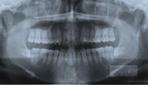 Print on transparent support PERIAPICAL OR PANORAMIC RADIOGRAPHS BEFORE