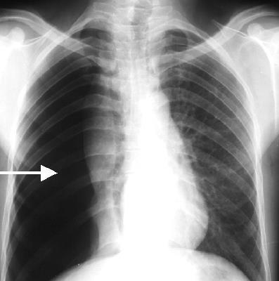 Collapsed Lung Pneumothorax Air escapes from the lung and fills the