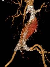 Extension with Renal Stents Nellix for EVAS