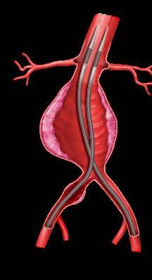 Introducing a New Therapy EVAS is not EVAR Concept based on sealing the aneurysm sac with polymerfilled endobags, potentially